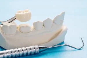 closeup prosthodontics prosthetic single teeth crown bridge equipment model express fix restoration