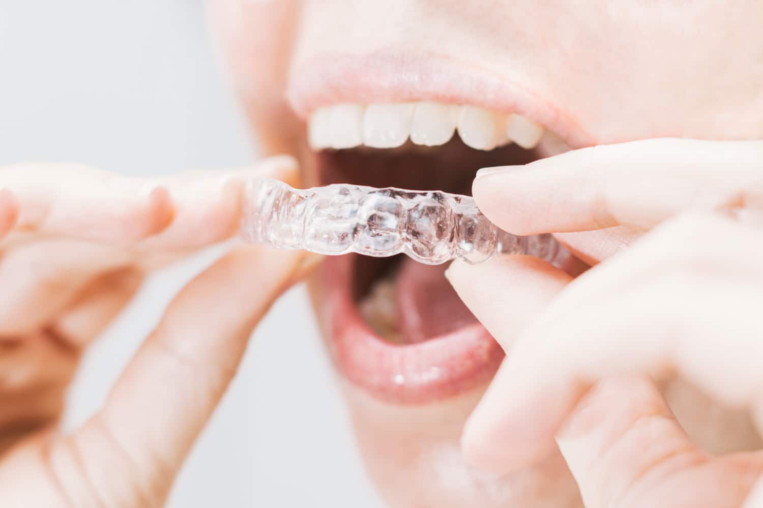 5 Signs You Need Braces, Invisalign, or Another Orthodontic Procedure