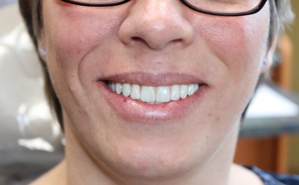 Amazing teeth alignment results