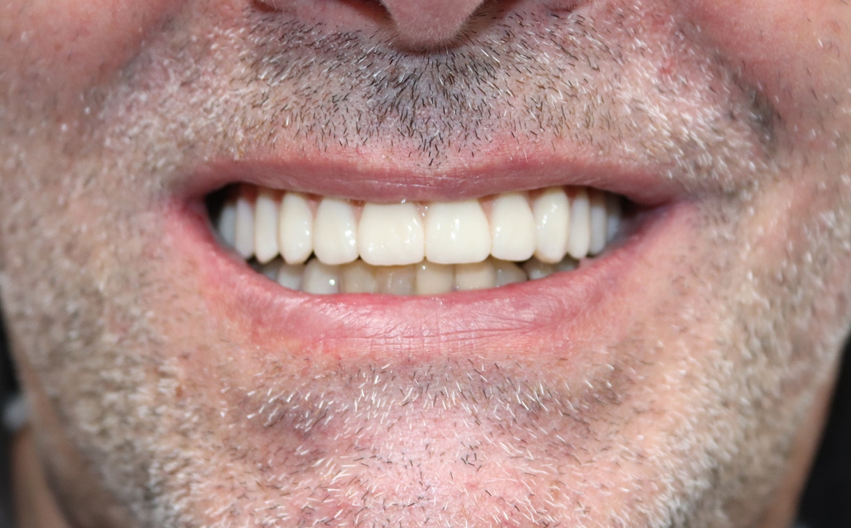 Teeth alignment treatment results