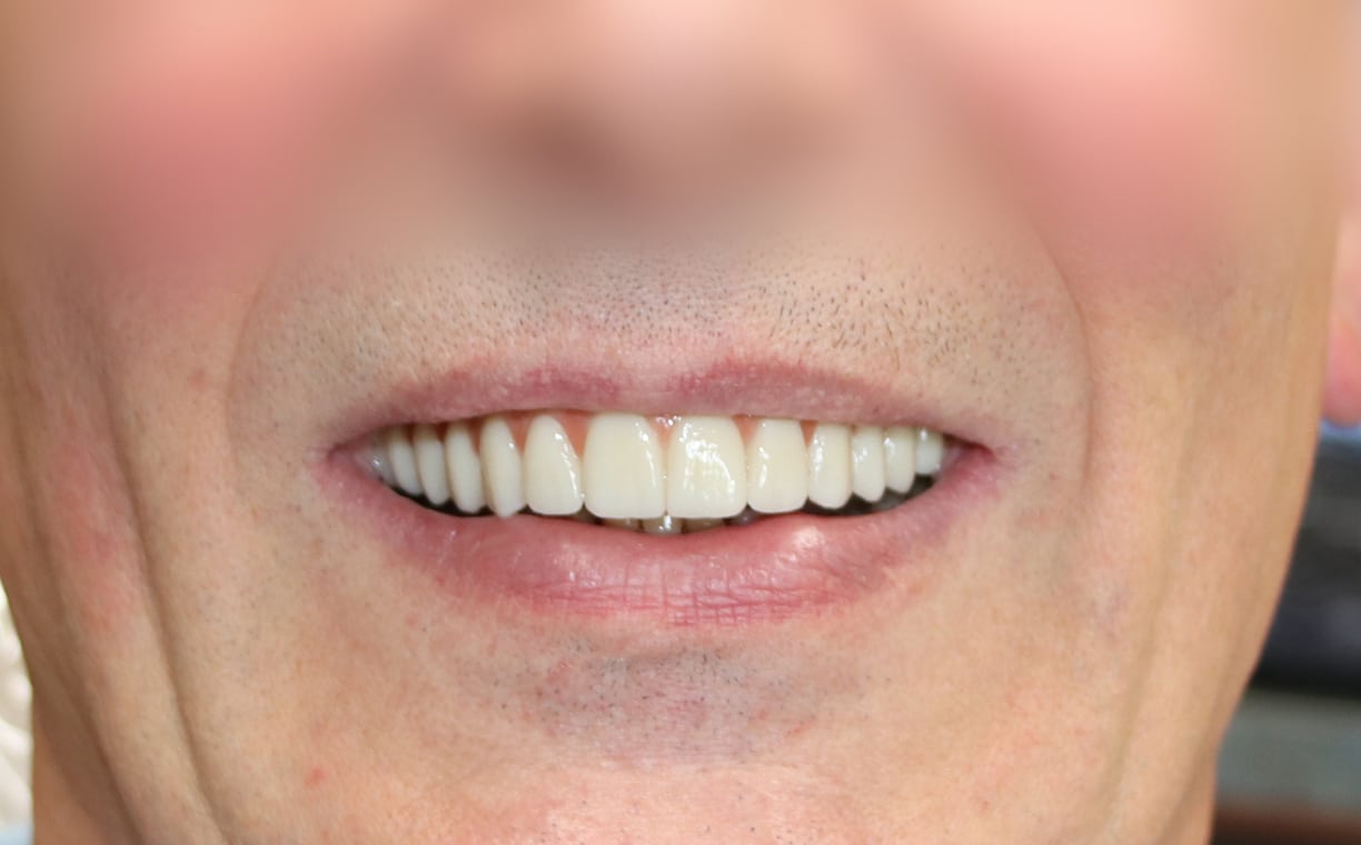 Patient showcasing Teeth alignment