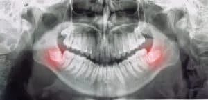 different types wisdom teeth problems concept problem teeth x ray image scanned panoramic image 1