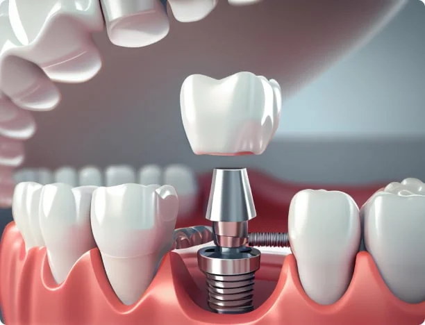 Crown Attached to a Dental Implant