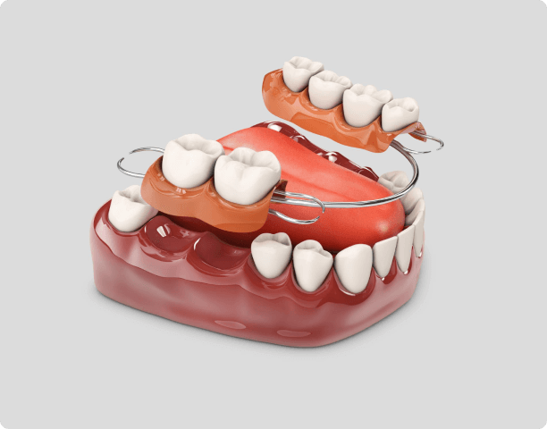 removable-partial-denture-medically-accurate-toothgenerative-ai 1 (3) (1)