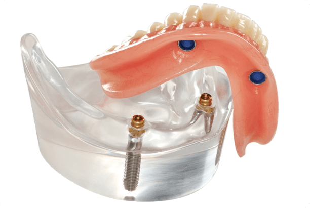removable-partial-denture-medically-accurate-toothgenerative-ai 1 (4) (1)