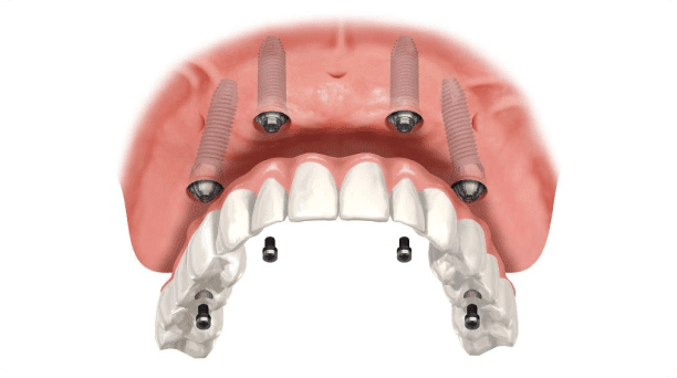 removable-partial-denture-medically-accurate-toothgenerative-ai 1 (5) (1)