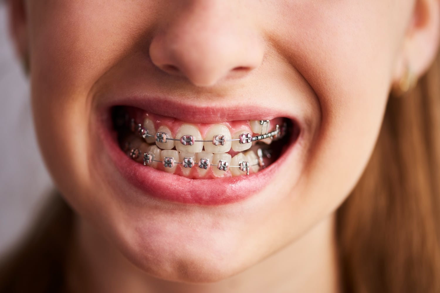 Be prepared for the school year with these easy tips for braces!
