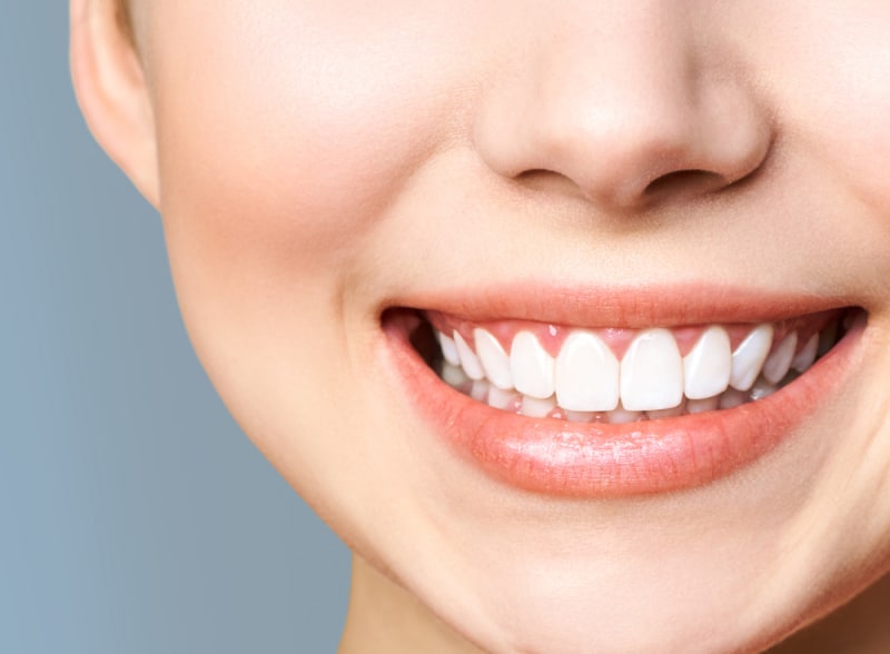 Teeth whitening result