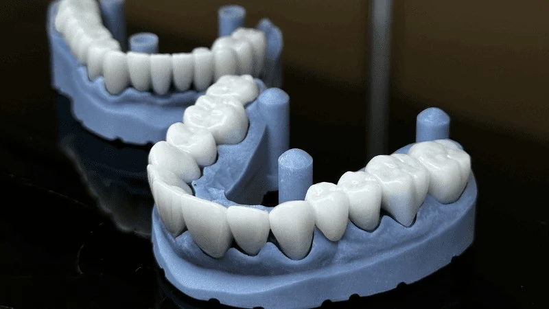 dental implants vs dental bridge