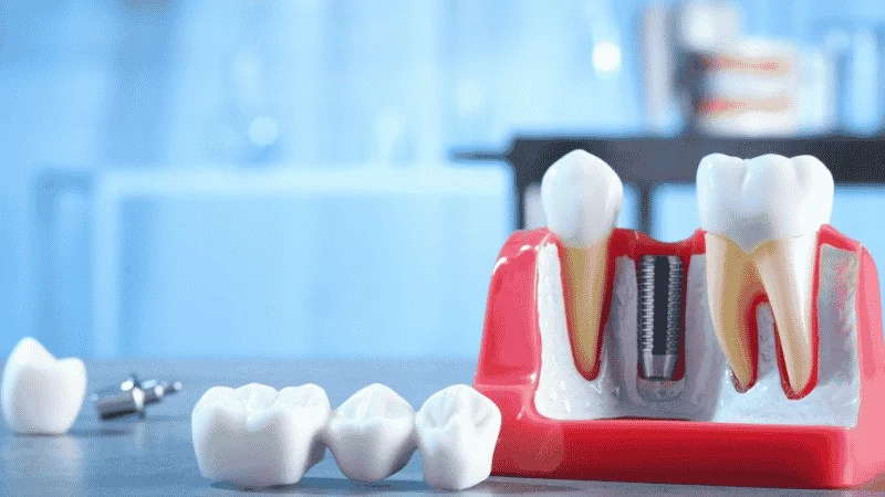 Choosing Between Dental Implants, Bridges, and More
