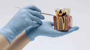 root canal vs tooth extraction