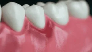 early signs of gum disease