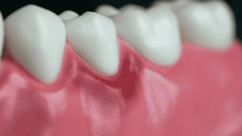 early signs of gum disease