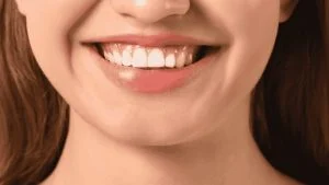 gummy smile treatment options