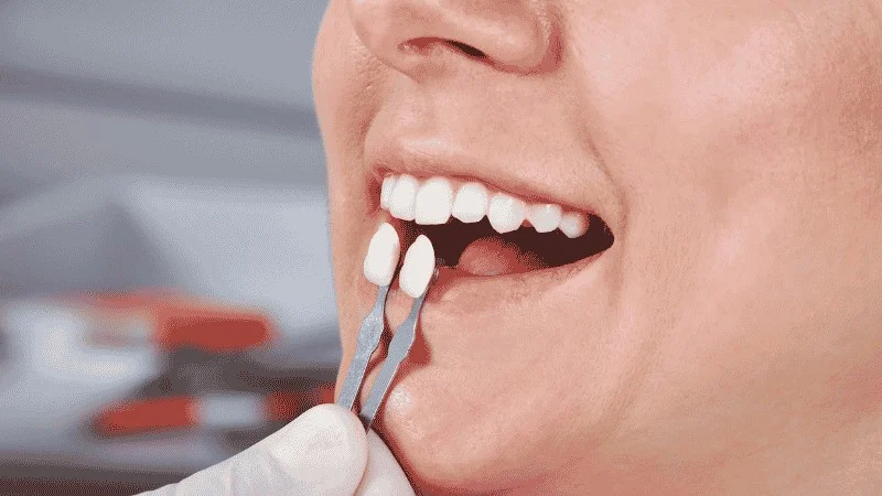 veneers vs bonding for chipped tooth