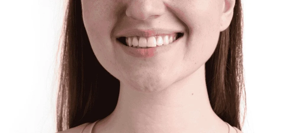veneers vs teeth whitening