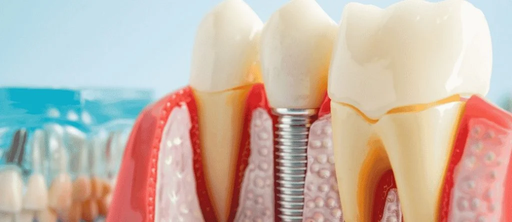 single tooth implant vs full arch dental implants
